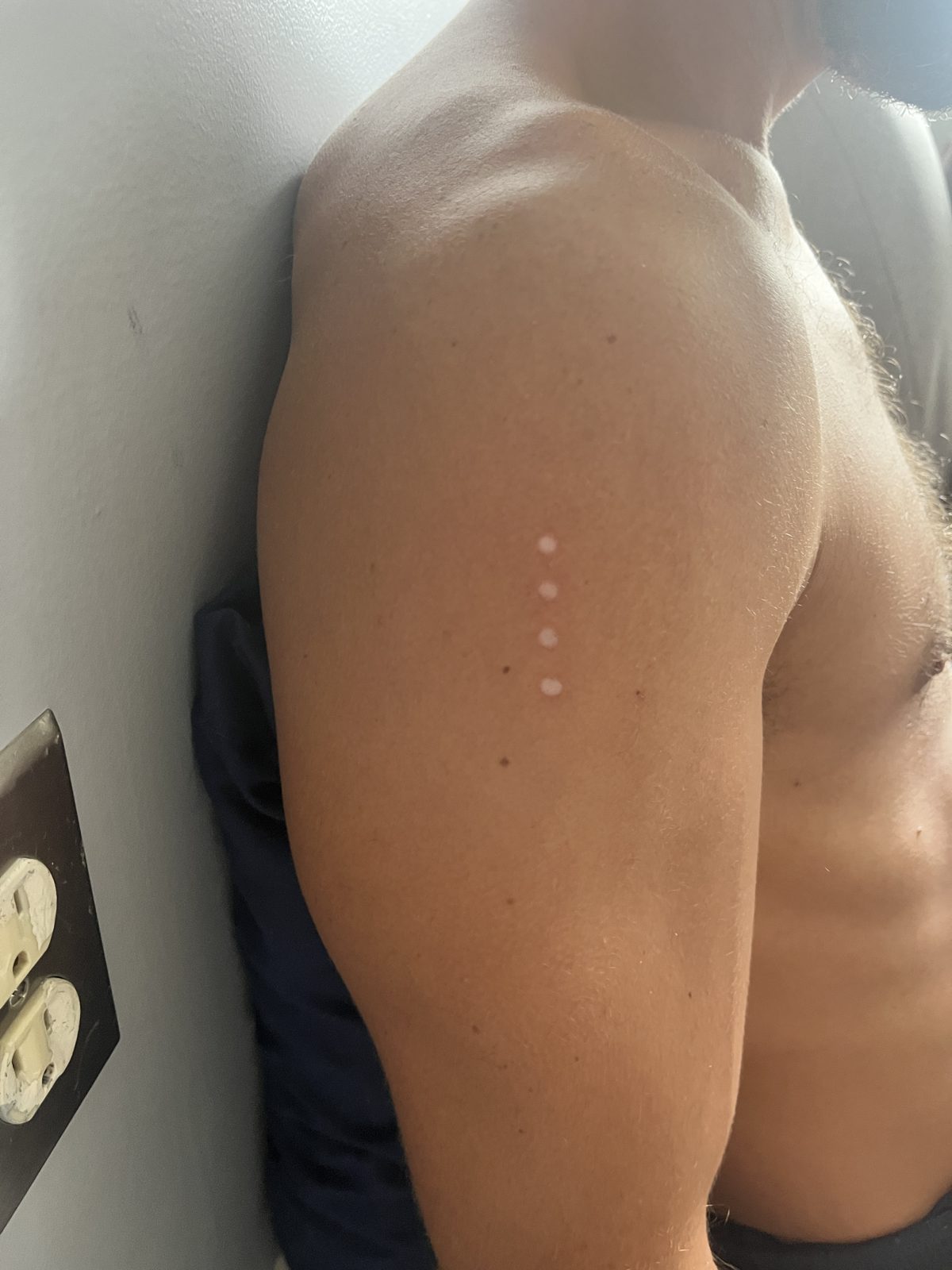 Close-up of a man's bare shoulder showing small white Kambo medicine burn marks on his arm after a Kambo ceremony